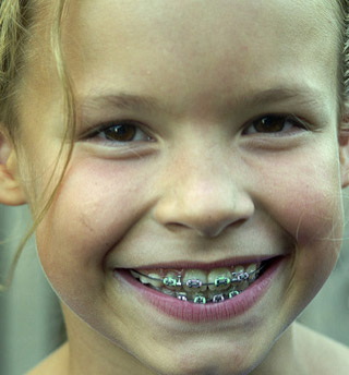 early orthodontic treatment